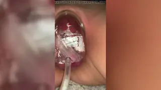 Woman Swells Her Lips With a Massive Pump